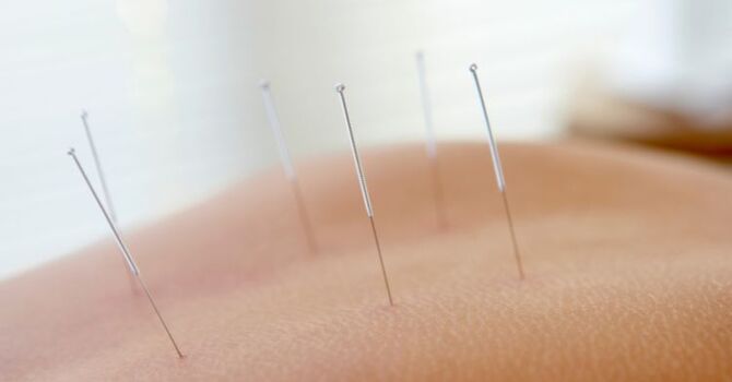 Acupuncture for Chronic Pain: Can It Finally Bring Relief?